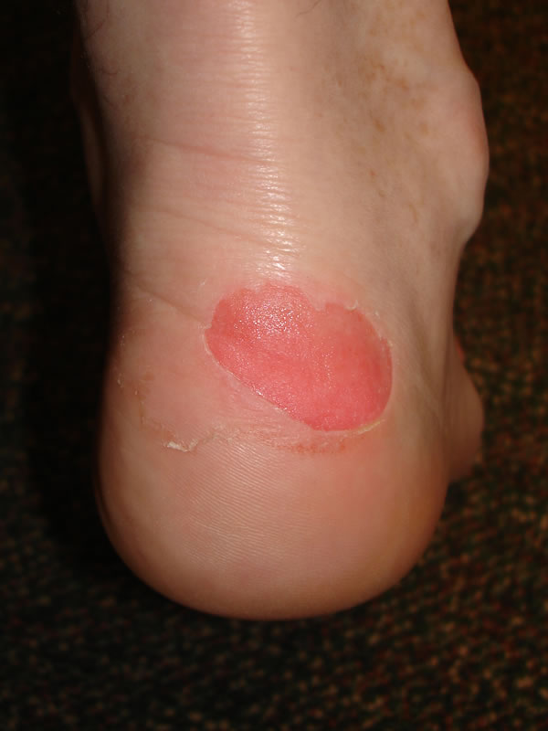 Heel Blister From Hiking