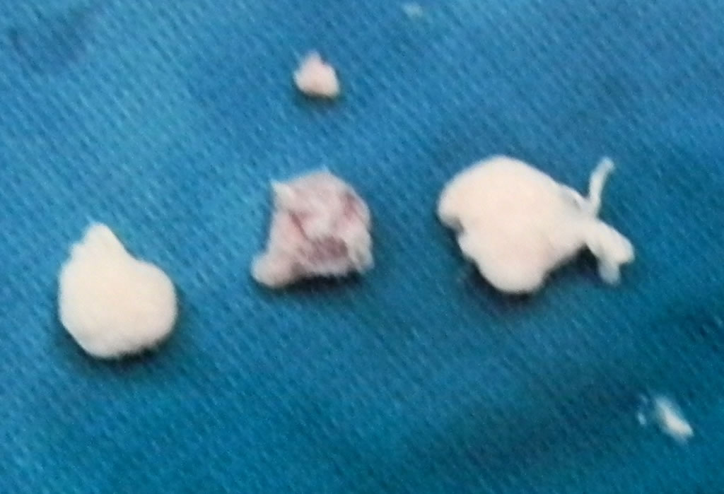 Loose bodies from my right knee